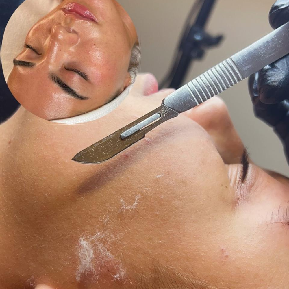 Dermaplaning