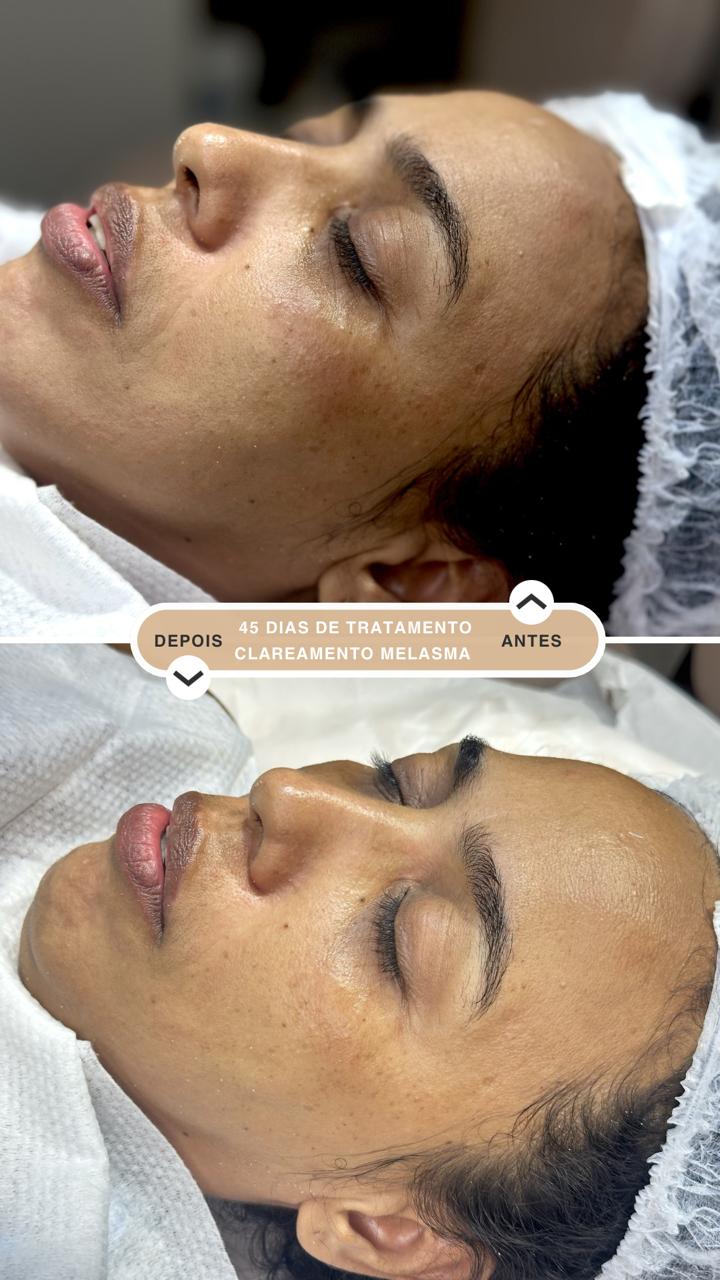 Melasma e Manchas Solares