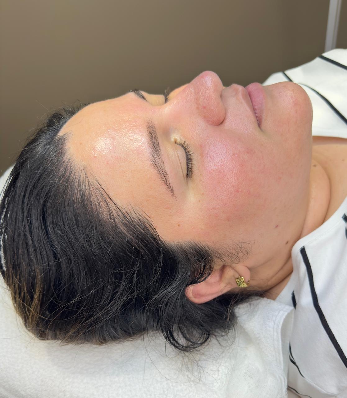Peeling químico
