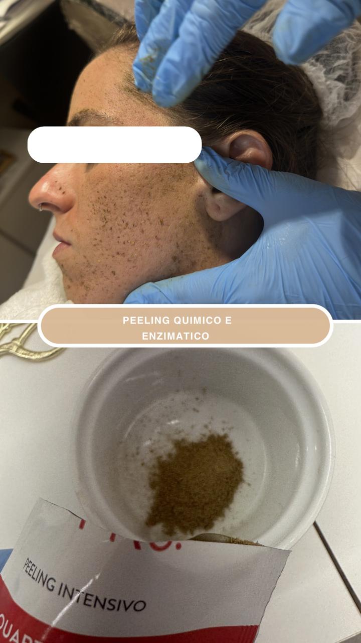 Peeling enzimático