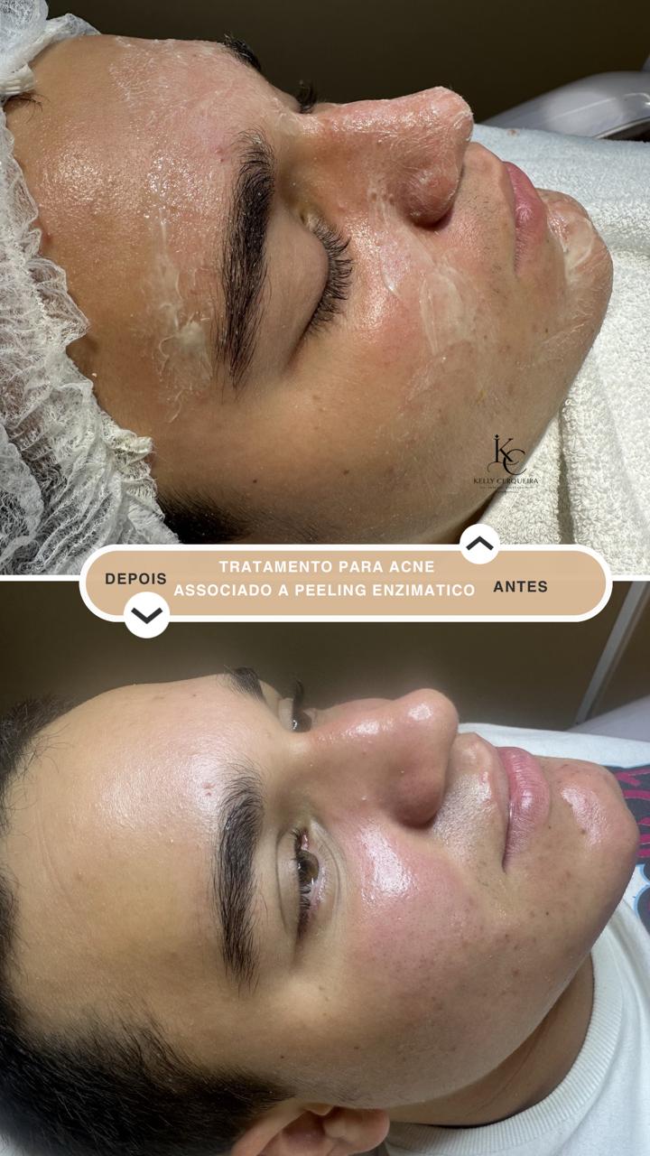Tratamentos contra Acne